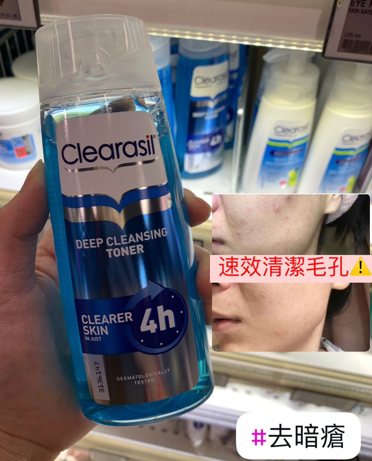 Clearasil速效深層清潔毛孔爽膚水，12小時內快速打開堵塞的毛孔，有助於防止暗瘡暗粒並縮小毛孔